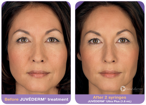 juvederm-before-after-2