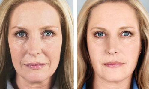 sculptra before and after Torrance CA