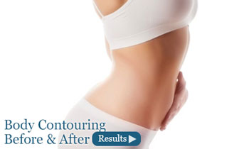 Before & After Body Contouring After Weight Loss Torrance, CA
