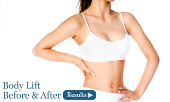 Body Lift Torrance CA Before & after