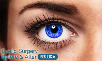 Eyelid Surgery Torrance