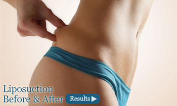 before and after Liposuction Torrance CA