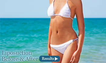 Liposuction Torrance CA before and after photo