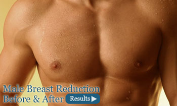 before and after Male Breast Reduction Torrance