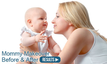 Mommy Makeover Torrance before and after photo
