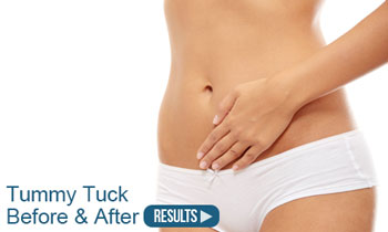 before and after tummy tuck torrance, ca