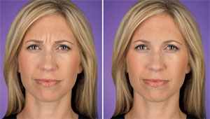 Botox Cosmetic before and after