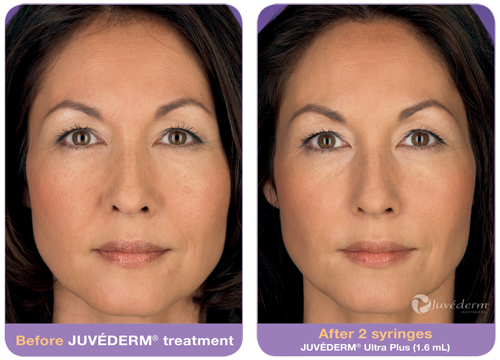 juvederm-before-after-2