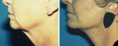 treating fat and loose skin under the chin