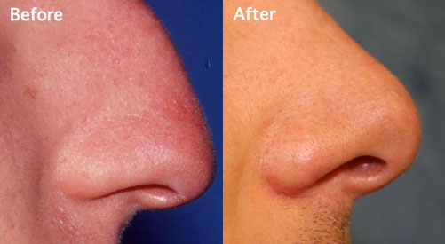 Man nose before and after Rhinoplasty procedure