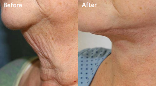 Old woman before and after Neck Lift procedure