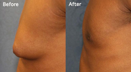 Man breast before and after breast reduction surgery