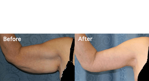Woman's arm Before and after Arm Lift Surgery