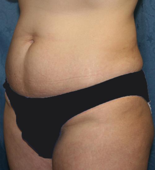 Liposuction