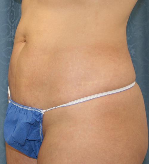 Liposuction