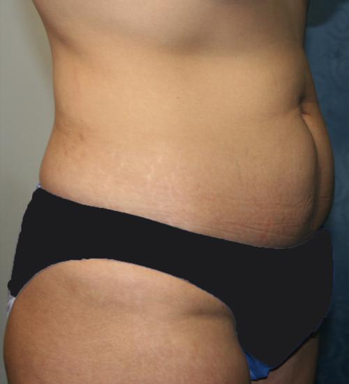 Liposuction