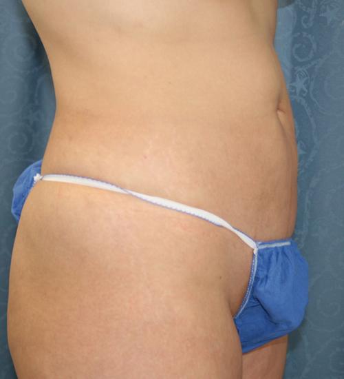 Liposuction