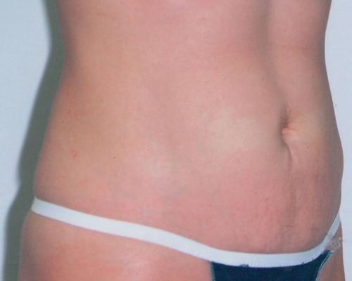 Body Contouring After Weight Loss Results Torrance