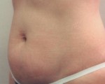 Liposuction