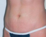 Liposuction