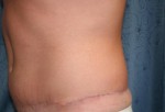 Tummy Tuck