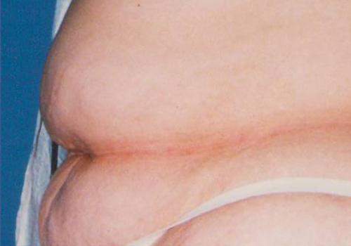 Tummy Tuck