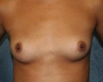 Breast Augmentation