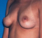 Breast Augmentation