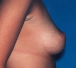 Breast Augmentation