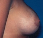 Breast Augmentation