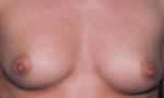 Breast Augmentation