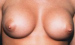 Breast Augmentation