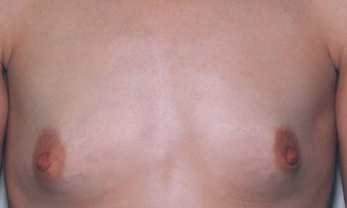 Breast Augmentation