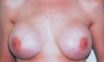 Breast Augmentation