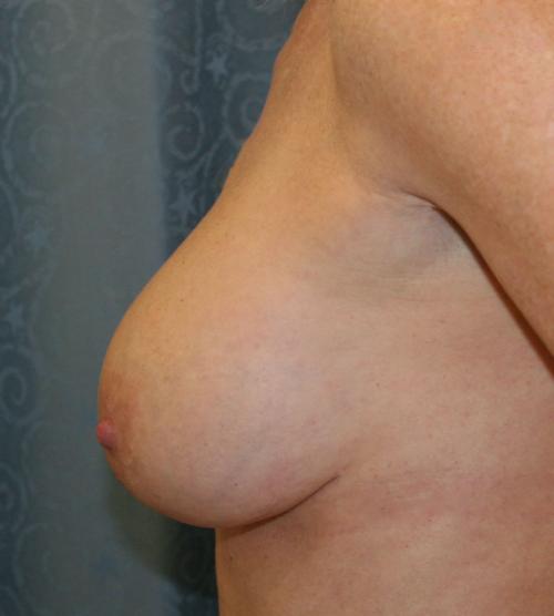 Breast Implant Revision and Capsule Removal