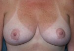 Breast Lift