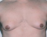 Male Breast Reduction