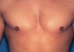 Male Breast Reduction