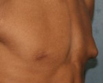 Male Breast Reduction