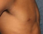 Male Breast Reduction