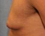 Male Breast Reduction