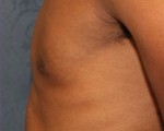 Male Breast Reduction