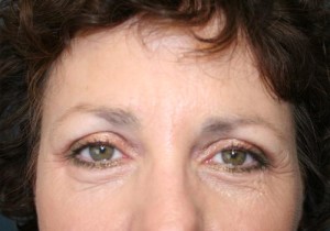 Brow Lift Result Torrance