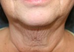 Face & Neck Lift