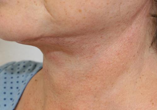 Face & Neck Lift