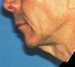 Face & Neck Lift