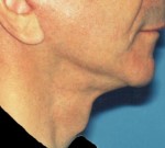 Face & Neck Lift