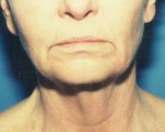 Face & Neck Lift