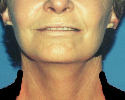 Face & Neck Lift