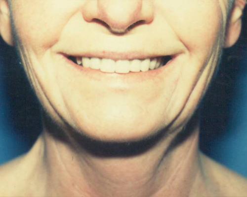 Face & Neck Lift